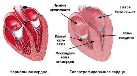 Причины дистрофии миокарда 2